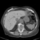 Amiodarone liver: CT - Computed tomography